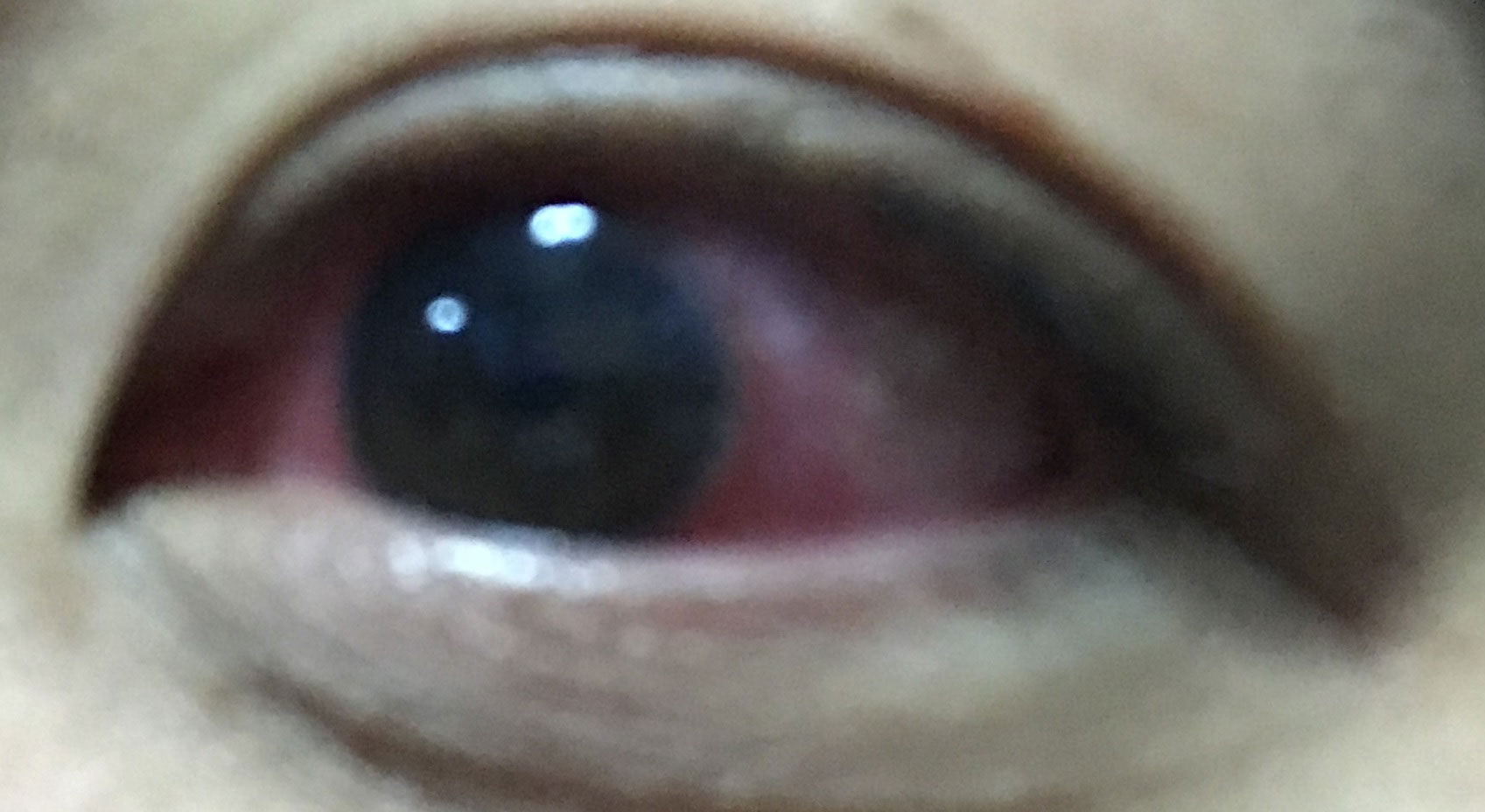 アカントアメーバ角膜炎|初期症状から完治【体験談ブログ】 エルキャリア